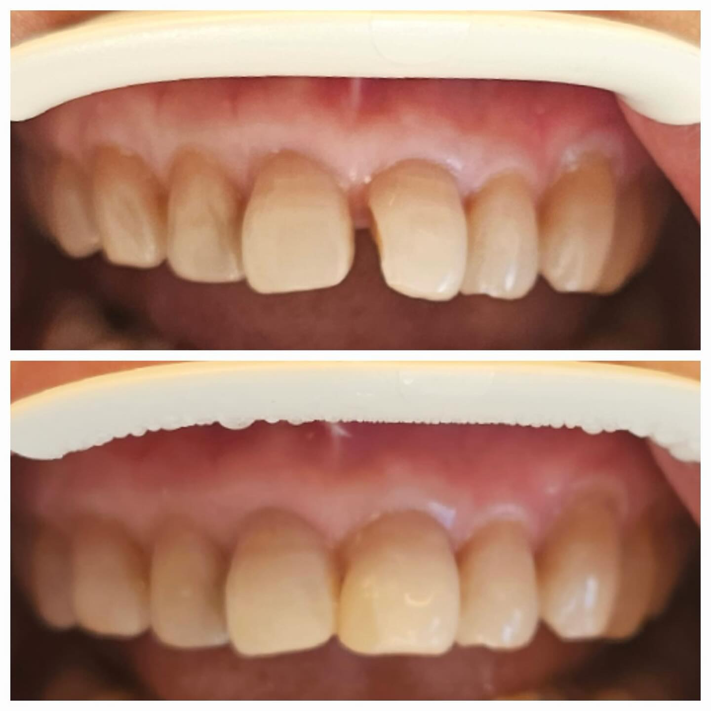 Före eller efter 🦷
Vår tandläkare Alaleh har lagat en framtand med en diskret och hållbar kompositfyllning som smälter in perfekt med den naturliga tanden. Estetik och funktion i perfekt harmoni
Vill du ha hjälp med en osynlig lagning? Välkommen att boka tid!
📞08-643 90 11
📧 info@gloss-floss.se
#tandvård #fyllning #framtand #estetisktandvård #kompositfyllning #leendemedstil #le #smil #dentist