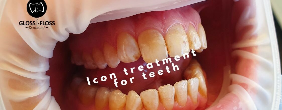 ICON treatment of the teeth