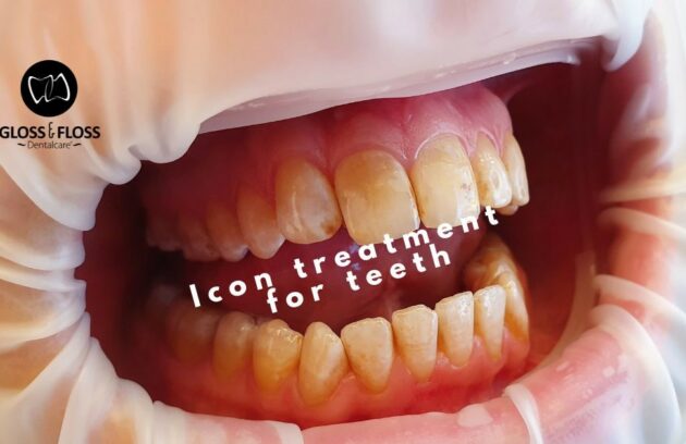 ICON treatment of the teeth. Therapy demonstration.