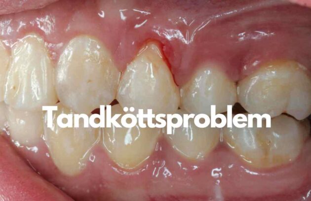 Tandköttsproblem- Tandköttskorrigering- Problems with tooth gums