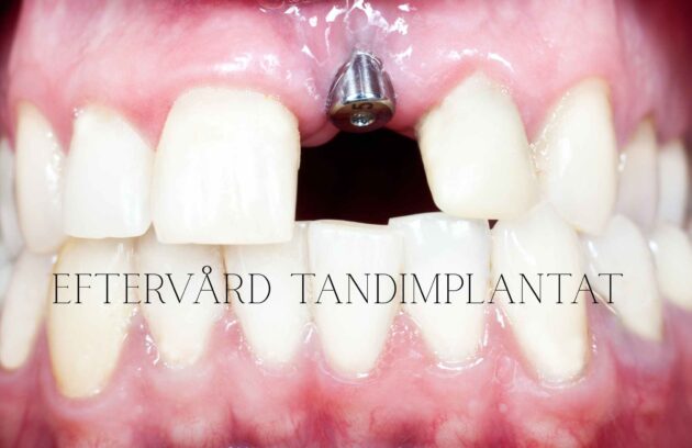 Eftervård tandimplantat: närbild på framtandsimplantat med synligt metall-abutment och rosa, frisk gingiva.