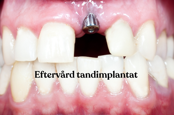 Eftervård tandimplantat: närbild på framtandsimplantat med synligt metall-abutment och rosa, frisk gingiva.