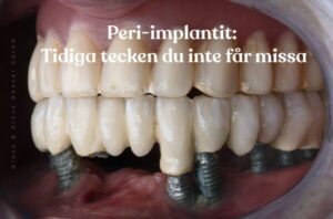 Närbild på tandimplantat med tecken på peri-implantit – lär dig tidiga varningstecken och förebygg komplikationer i Stockholm