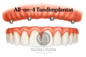 All-on-4 tandimplantat i överkäke – fast helkäksbro på fyra implantat hos Gloss & Floss Dental Care i Stockholm.