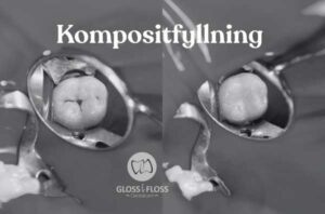 Närbild av tand med kompositfyllning under behandling – tandfärgad fyllning och hållbar metod utförd hos Gloss & Floss Dental Care i Stockholm.