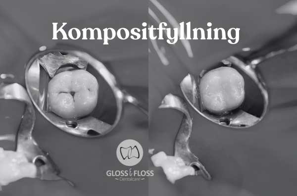 Närbild av tand med kompositfyllning under behandling – tandfärgad fyllning och hållbar metod utförd hos Gloss & Floss Dental Care i Stockholm.
