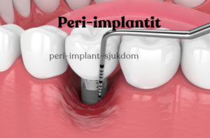 Peri-implantit – inflammation runt tandimplantat som visar benförlust och sondering vid Gloss & Floss Dental Care Stockholm.