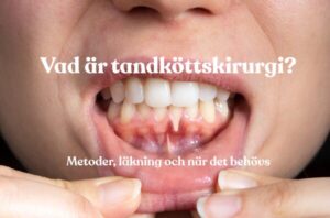 Närbild av tandkött inför tandköttskirurgi – tandköttskirurgi och läkning med moderna metoder hos Gloss & Floss Dental Care i Stockholm.