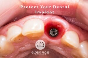 Dental implant in the upper jaw illustrating dental implant maintenance in Stockholm at Gloss & Floss Dental Care