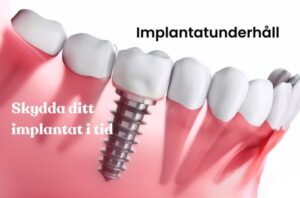 Tandimplantat som illustrerar implantatunderhåll och implantatkontroll i Stockholm hos Gloss & Floss Dental Care