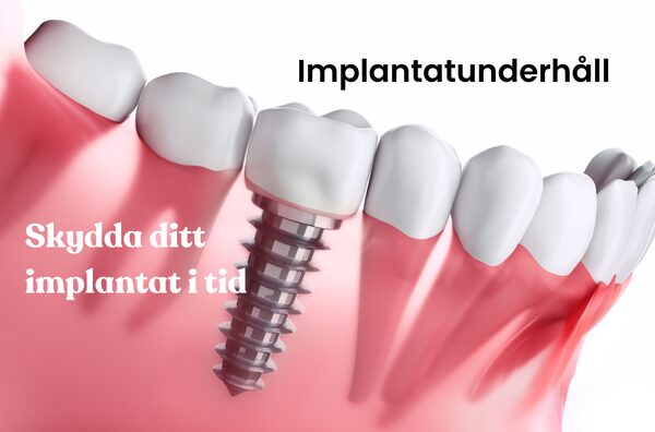 Tandimplantat som illustrerar implantatunderhåll och implantatkontroll i Stockholm hos Gloss & Floss Dental Care