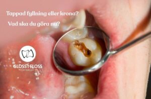 Tappad fyllning eller krona i kindtand som undersöks med munspegel hos Gloss & Floss i Stockholm